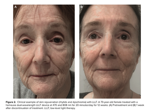 Does Red Light Therapy really work? A Clinical Trial